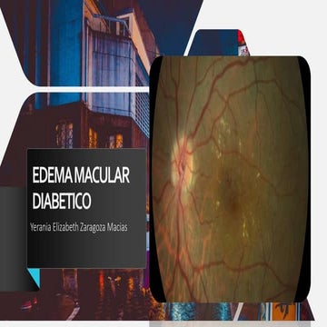 EDEMA MACULAR DIABETICO