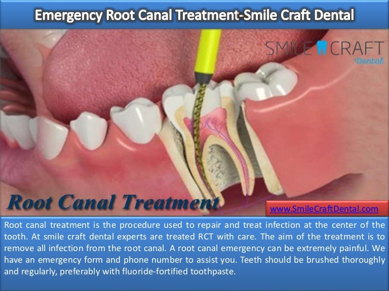 Emergency root canal treatment smile craft dental