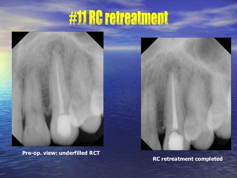 Endodontic Clinical Cases