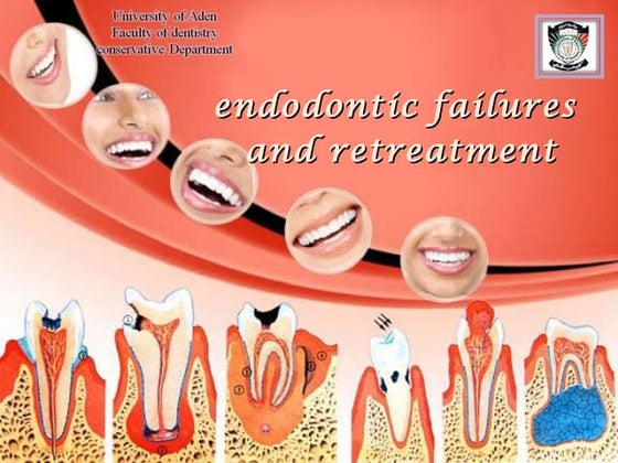 Root canal preparation techniques _ endodontic treatment | PPTX | Oral ...