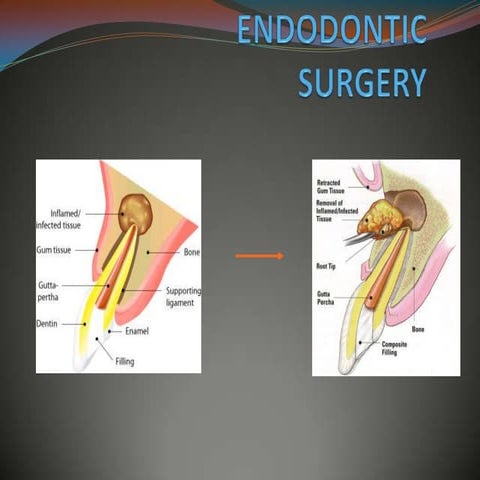 Endodontic surgery