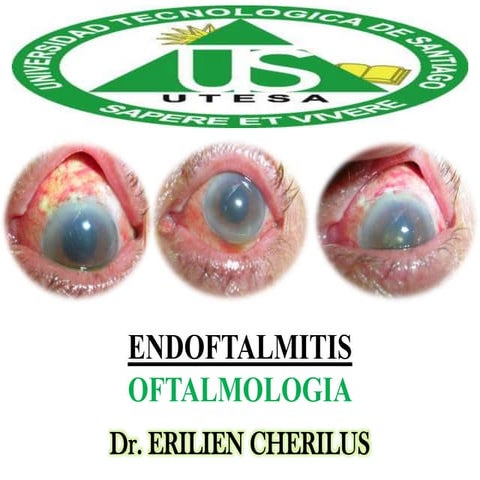 Endoftalmiitis - Oftalmologia | PPTX