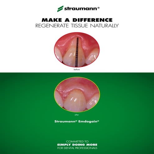 Impression Taking Components for Straumann | PDF