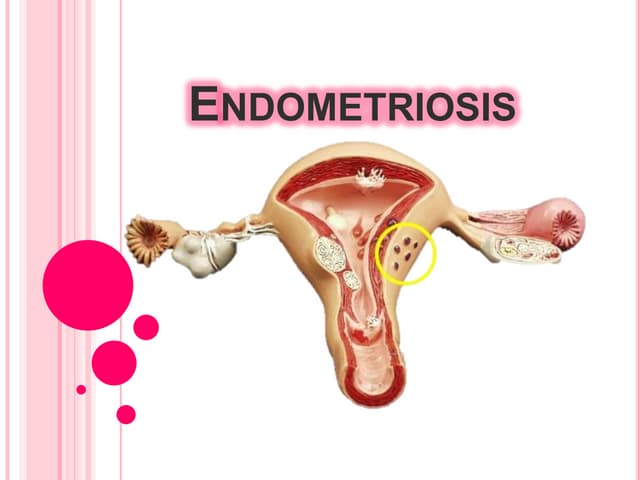 Endometriosis