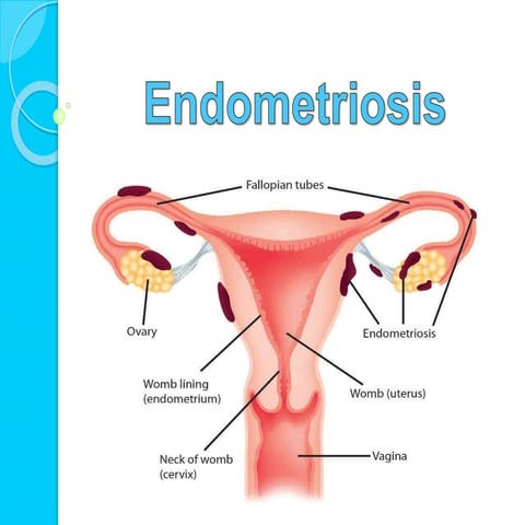 Endometriosis