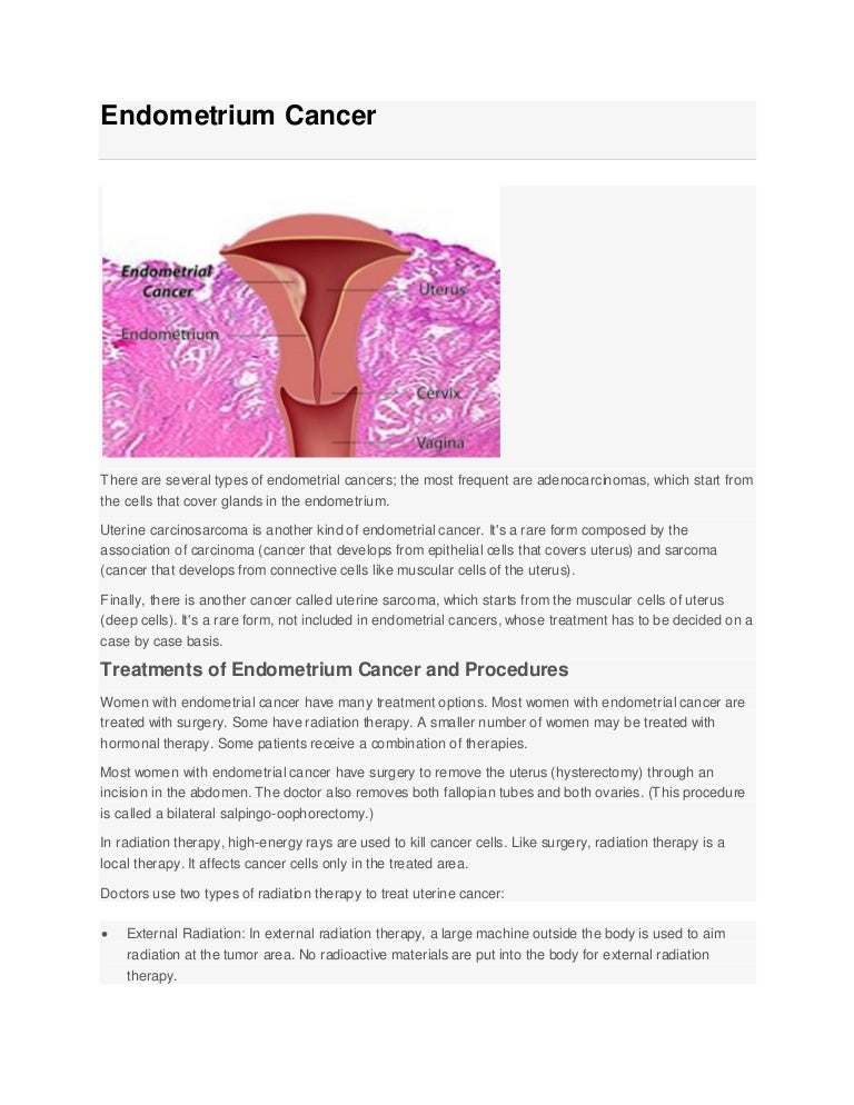 Endometrial Cancer Treatment Treatment of Endometrial in