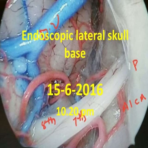 Endoscopic lateral skull base