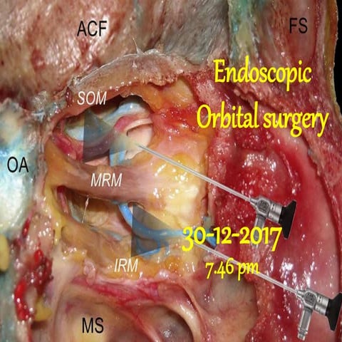 Endoscopic orbital surgery