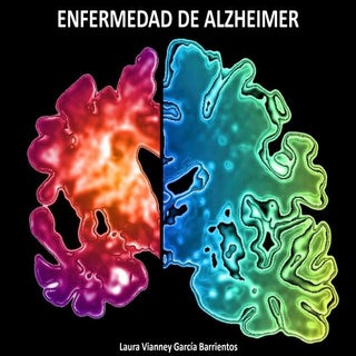 Enfermedad de alzheimer