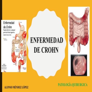 Enfermedad de crohn | PPTX