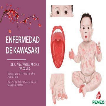 Enfermedad de Kawasaki (Enfoque en Pediatría)