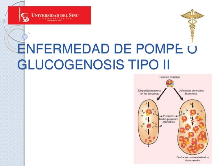 Enfermedad De Pompe