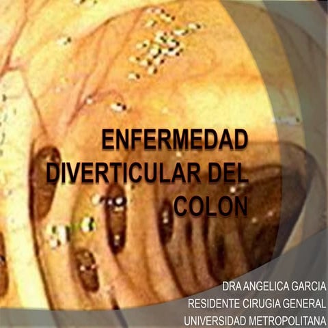 Enfermedad diverticular del colon | PPTX