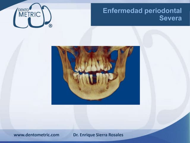 Enfermedad periodontal