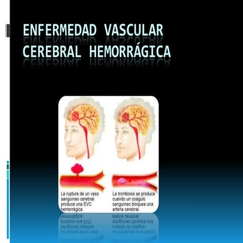 Enfermedad vascular cerebral hemorrágica