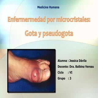 Enfermermedad por microcristales