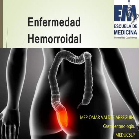 Hemorroides htca 2016 | PPTX