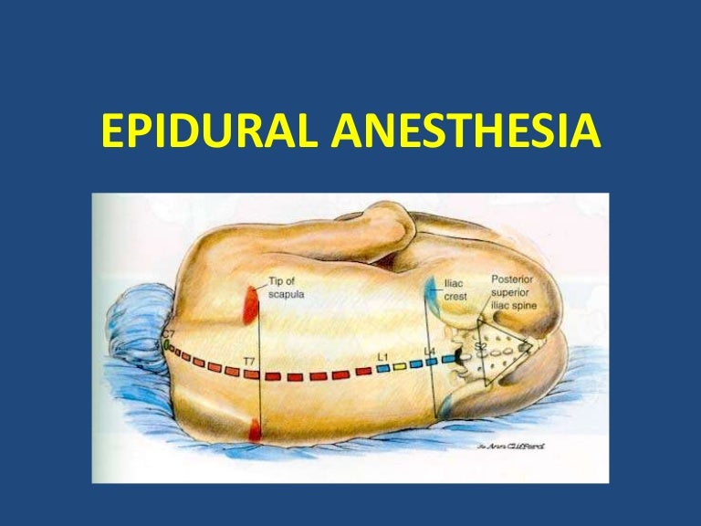 Epidural anesthesia