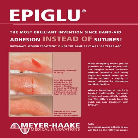 Epiglu kuwait (1) | PDF