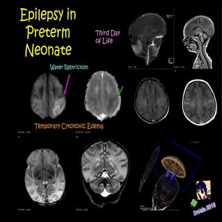 Epilepsy in Preterm Neonate MRI