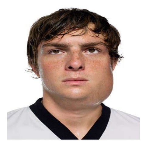 EPIDEMIOLOGY OF MUMPS