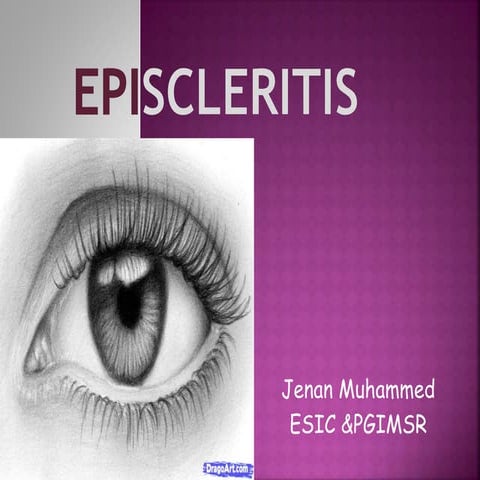 Episcleritis 