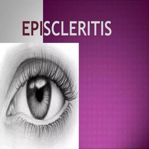 EPISCLERITIS & UVEITIS.ppt eye disorders