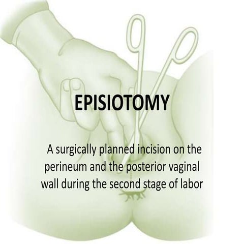 Episiotomy | PDF