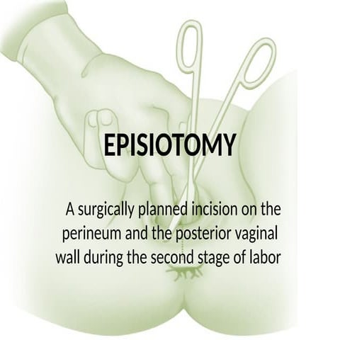 episiotomy procedure medio lateral .pptx