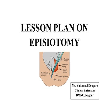EPISIOTOMY types,purposes,procedures ppt | PPT