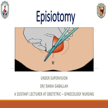 Episiotomy | PPTX
