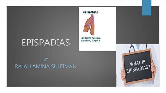 Epispadiasis.pptx