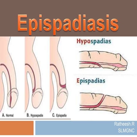 epispadiasis-200430092548-thumbnail.jpg?width=640&height=640&fit=bounds