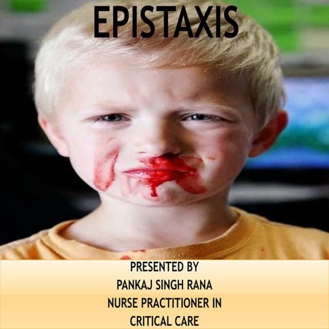Epistaxis ( nose bleed)