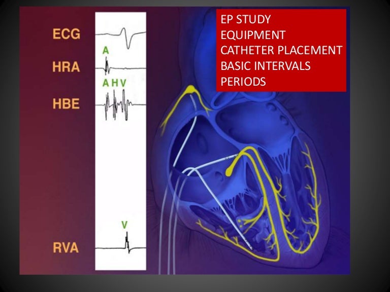 Electrophysiology study basics