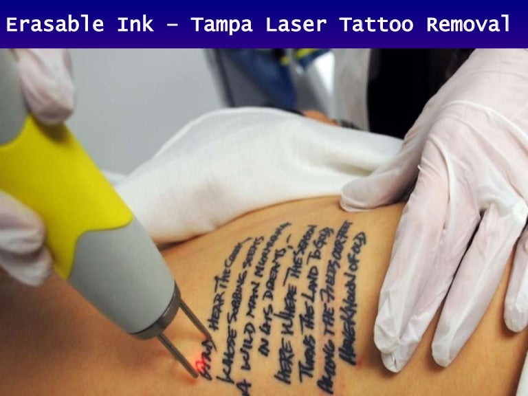 Tampa Laser Tattoo Removal