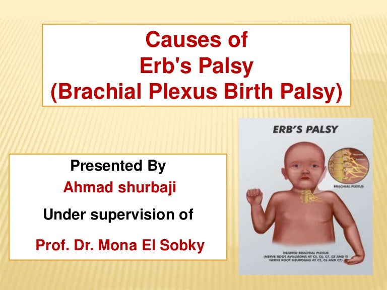 erb s palsy cause erb palsy