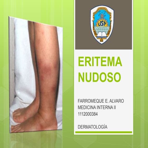 Eritema nudoso