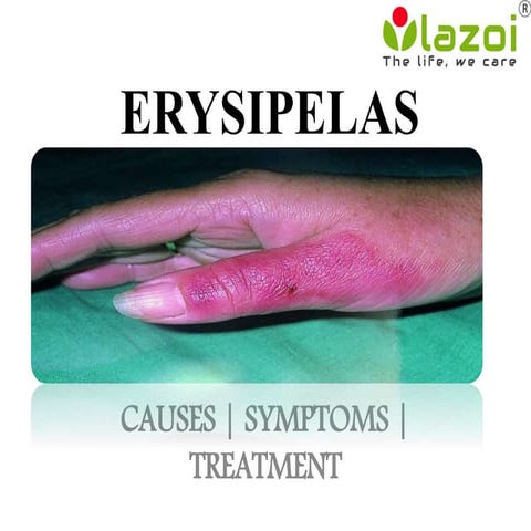 Erysipelas : causes, symptoms, diagnosis, prevention and treatments