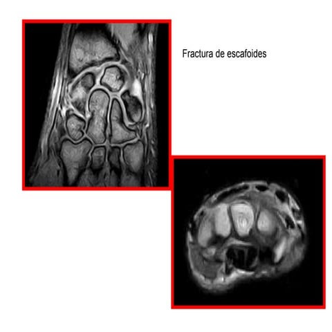 Escafoides por Resonancia Magnetica