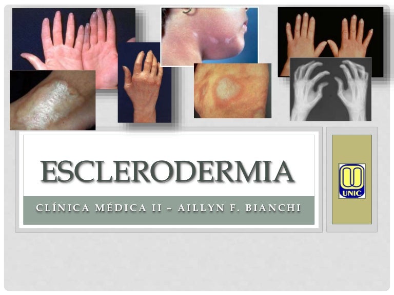 Esclerodermia - Clínica Médica