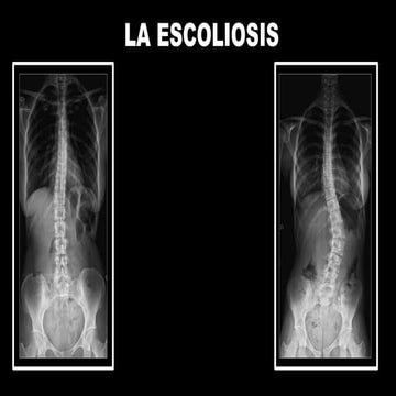 escoliosis-191215171633 (1).pptxjjjjjjjj