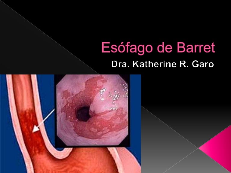 Esófago de barret
