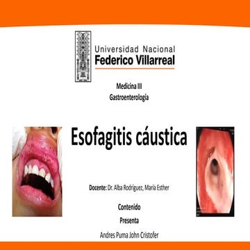 ESOFAGITIS | PPTX