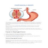 Esophageal Cancer: All You Need to Know
