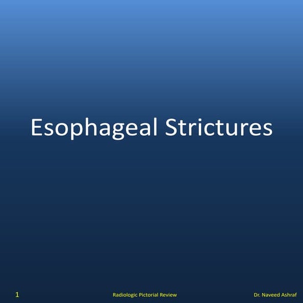 Esophageal Strictures
