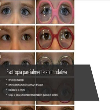 Esotropía parcialmente acomodativa.pptx