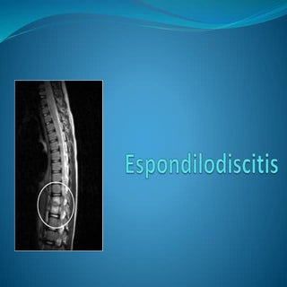 Espondilodiscitis