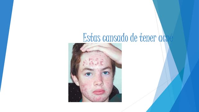 Estas cansado de tener acné