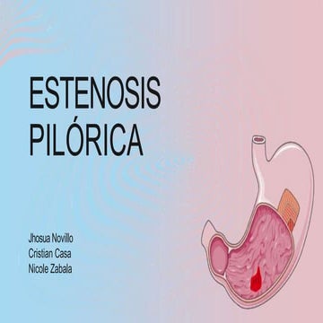 estenosispilrica-230516003255-6d8d0b4f.pptx